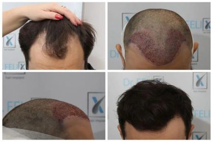 de ce sa alegi clinica dr felix hair implant pentru a afla un pret pentru implant par vezi aici 66c2f2e7062f1