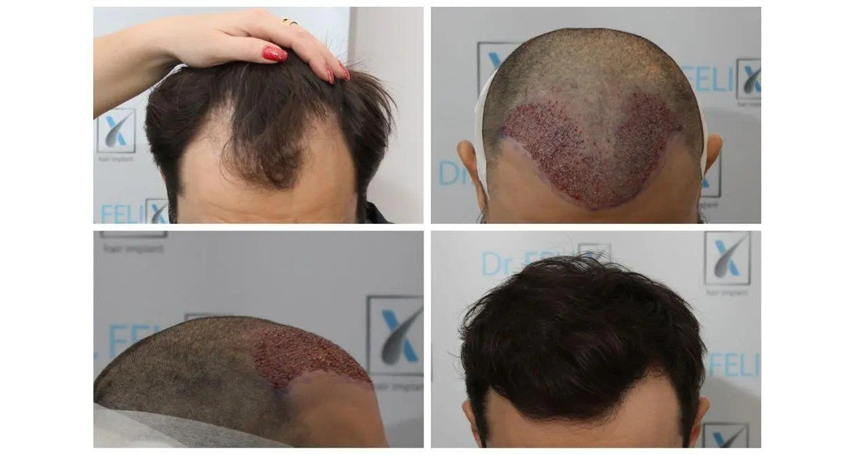 de ce sa alegi clinica dr felix hair implant pentru a afla un pret pentru implant par vezi aici 66c2f2e7062f1